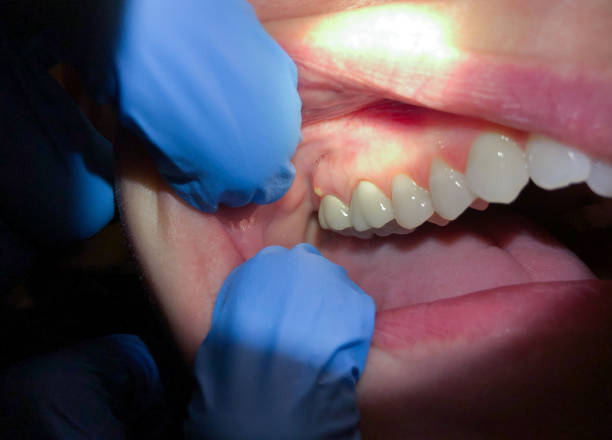 Best Knocked-Out Tooth (Avulsed Tooth) Treatment in Baden, MD